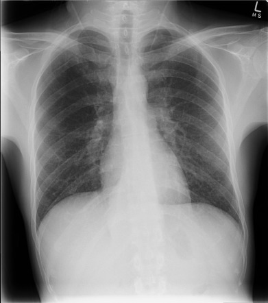 Disseminated tuberculosis | Radiology Case | Radiopaedia.org