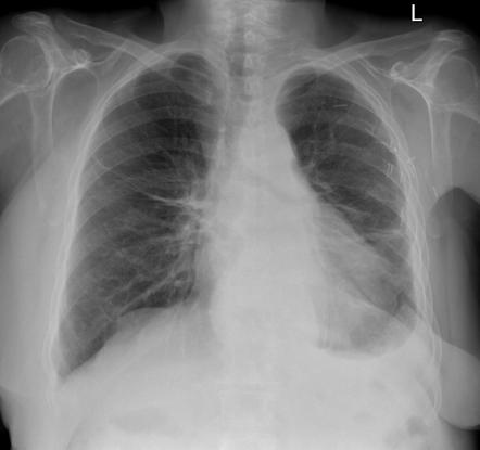 Breast cancer metastasis | Radiology Case | Radiopaedia.org