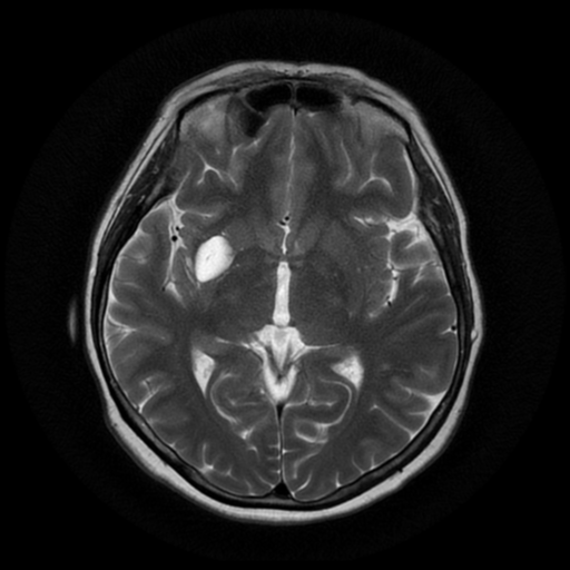 Perivascular space | Image | Radiopaedia.org