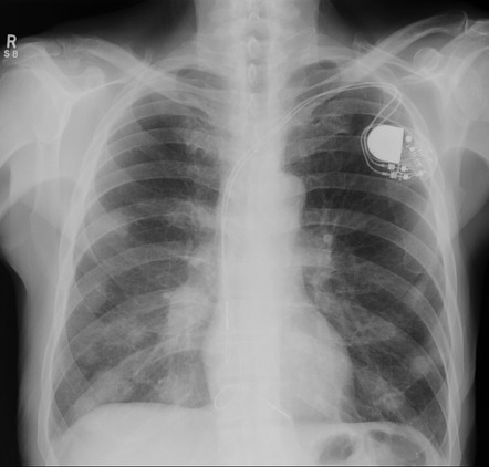 Cannonball metastases (lungs) | Radiology Reference Article ...