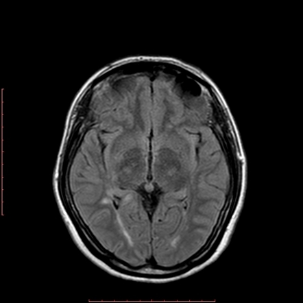 Multiple sclerosis | Radiology Case | Radiopaedia.org