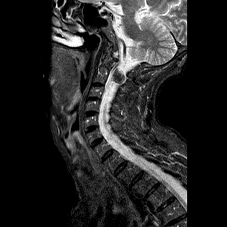 Spinal meningioma - cervical | Radiology Case | Radiopaedia.org