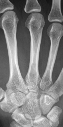 Enchondroma - metacarpal bone | Image | Radiopaedia.org