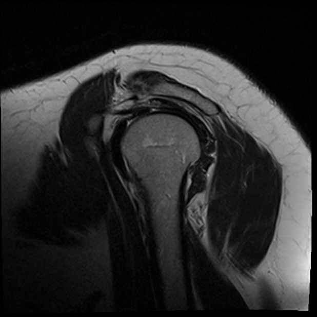 Calcific Tendinitis Supraspinatus Tendon Image