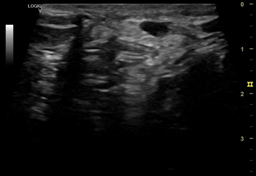 Testicular Atrophy Unilateral Image