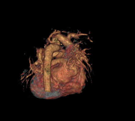 Coarctation of the aorta and patent ductus arteriosus | Image ...