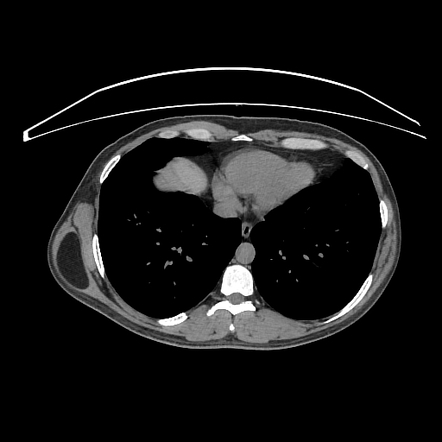 Intramuscular Lipoma Radiology Reference Article Radiopaedia Org