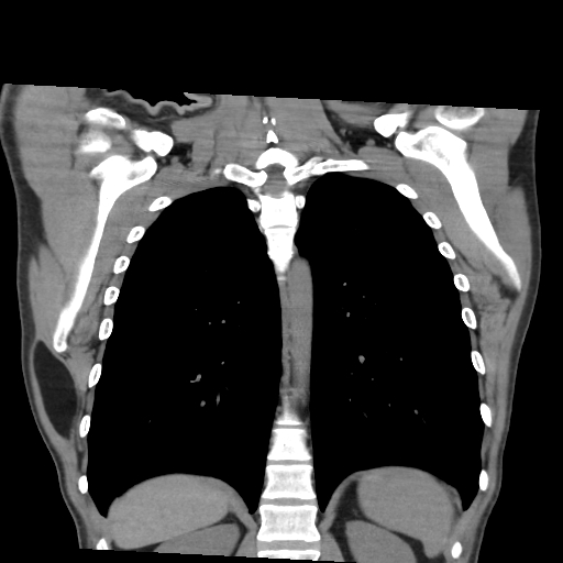 Intramuscular Lipoma Latissimus Dorsi Image