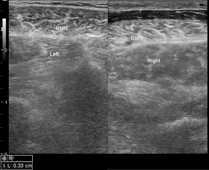 ruptured-popliteal-cyst-image-radiopaedia