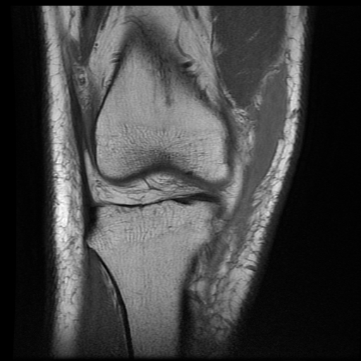 MorelLavallée lesion with ACL sprain knee Image