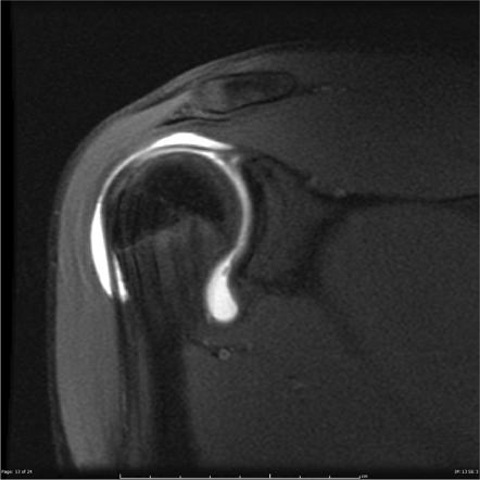 Perthes lesion | Radiology Case | Radiopaedia.org