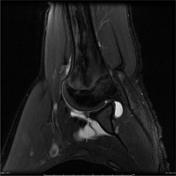 Perthes lesion | Radiology Reference Article | Radiopaedia.org