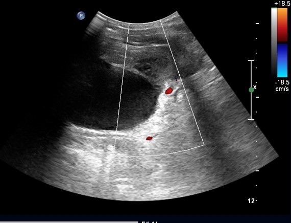 Splenic Hydatid Cyst Image 7387