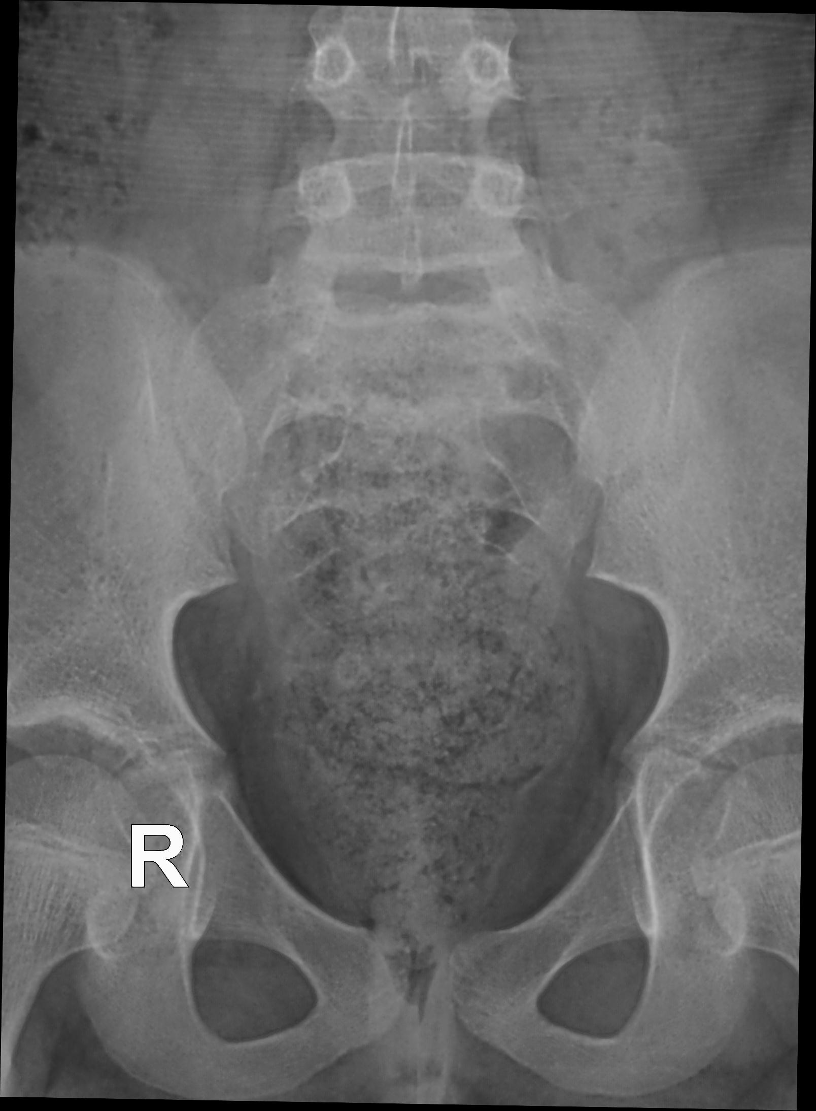 Coccyx fracture | Image | Radiopaedia.org