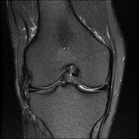 Horizontal tears - medial and lateral menisci | Radiology Case ...