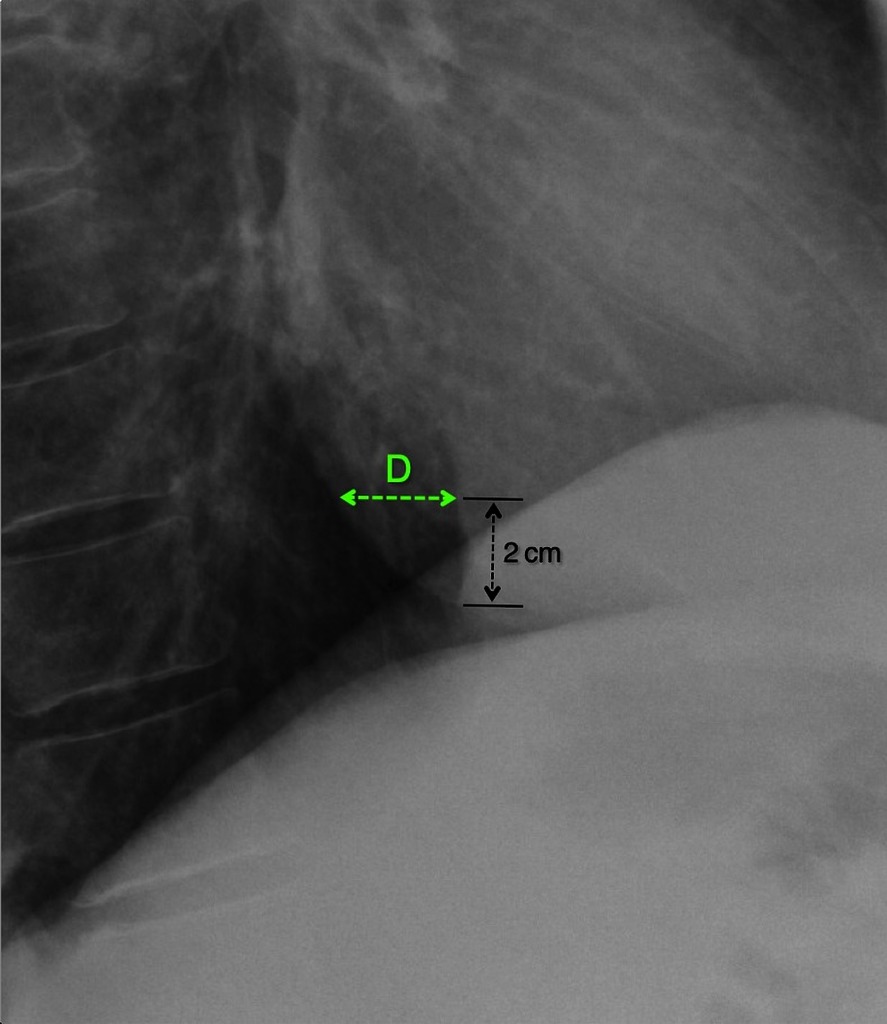 Hoffman Rigler Sign Of Left Ventricular Enlargement Radiology Case Radiopaedia Org