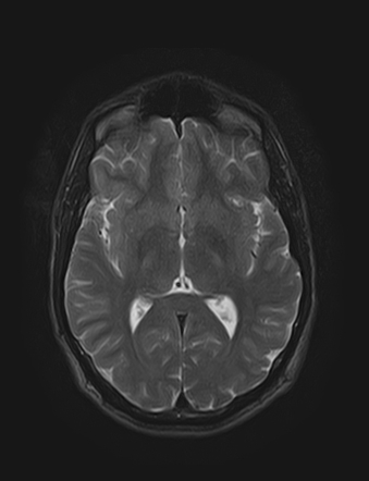 Traumatic arteriovenous fistula of scalp | Image | Radiopaedia.org