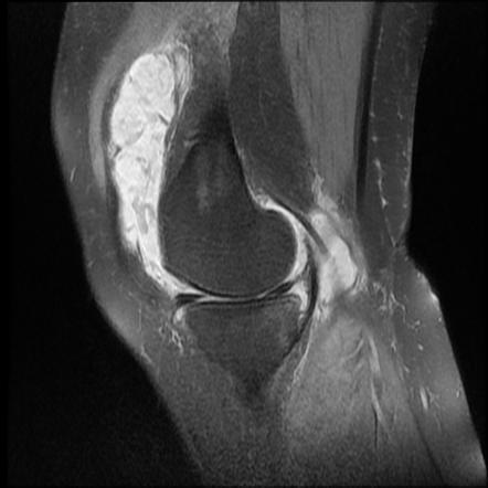 Rheumatoid arthritis (musculoskeletal manifestations) | Radiology ...