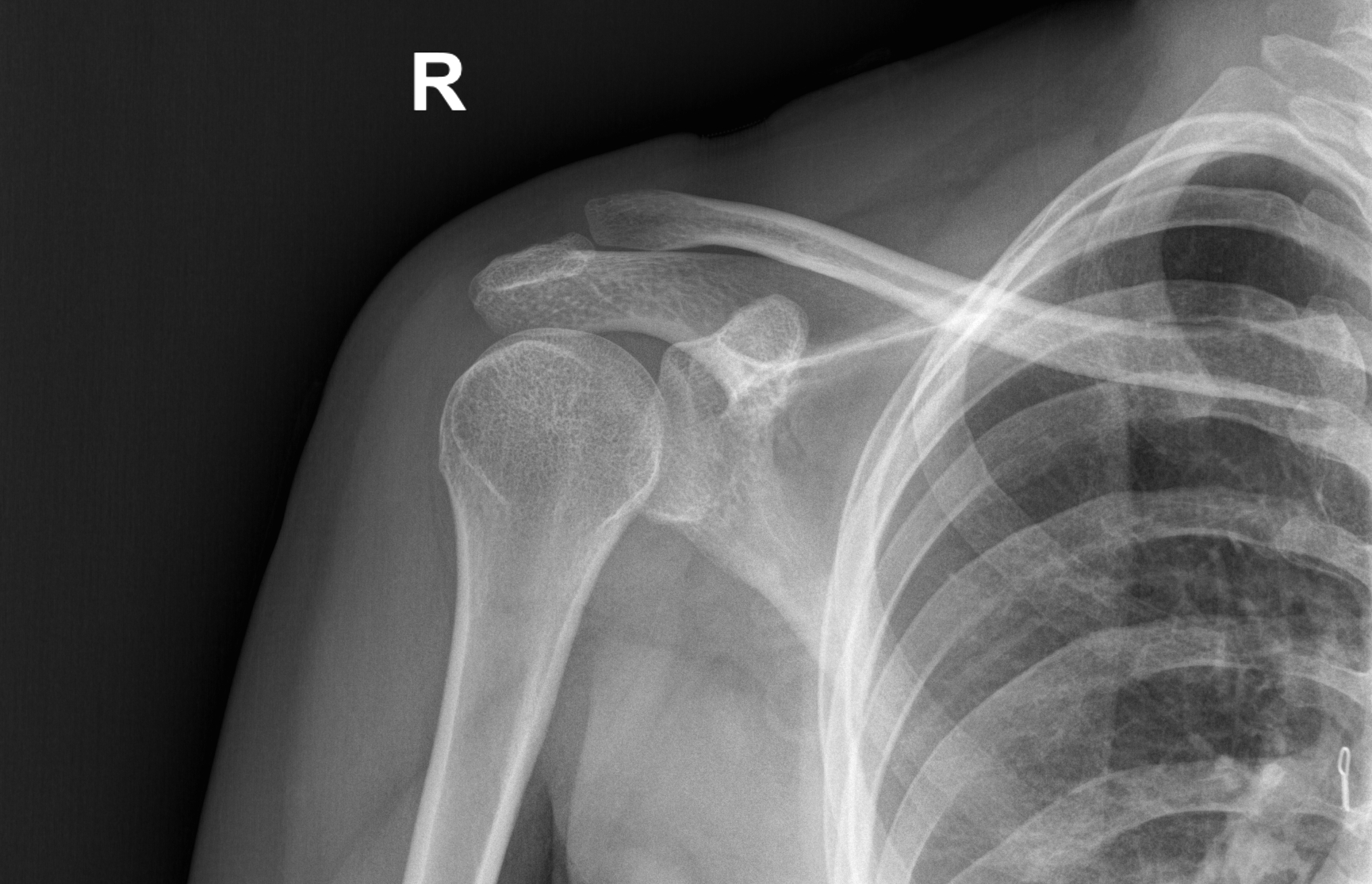 Right Acromioclavicular Joint Subluxation 