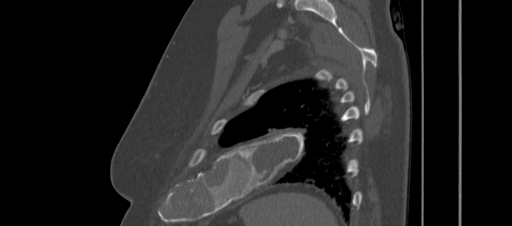 Fibrous dysplasia - rib | Image | Radiopaedia.org