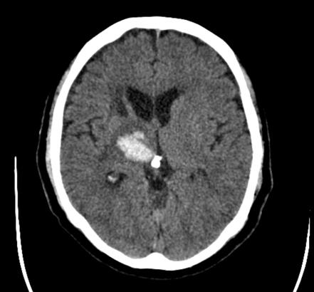 Basal ganglia hemorrhage | Radiology Reference Article | Radiopaedia.org