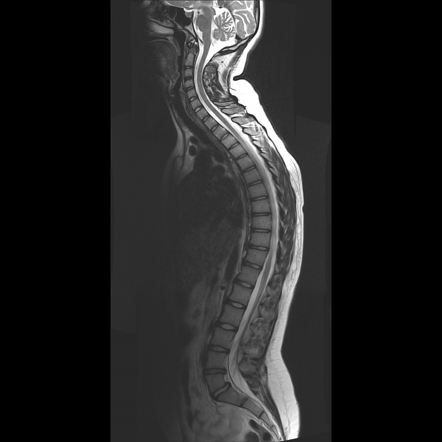 Scheuermann disease | Image | Radiopaedia.org