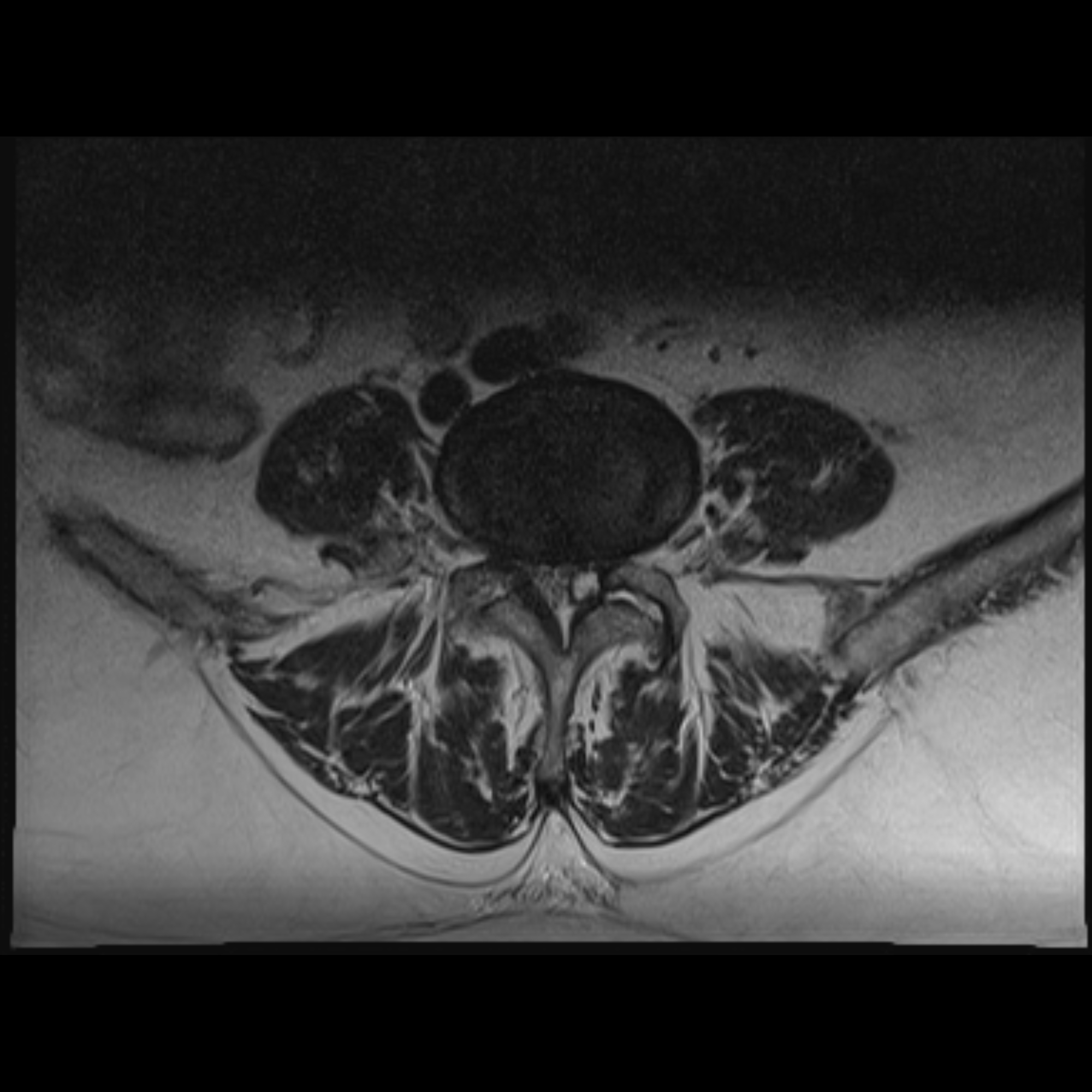 Spinal Synovial Cyst Image 