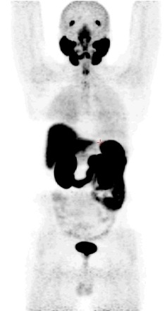 Normal physiological distribution (Ga-68 PSMA PET scan) | Radiology