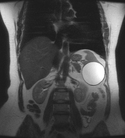 Splenic cyst | Radiology Case | Radiopaedia.org