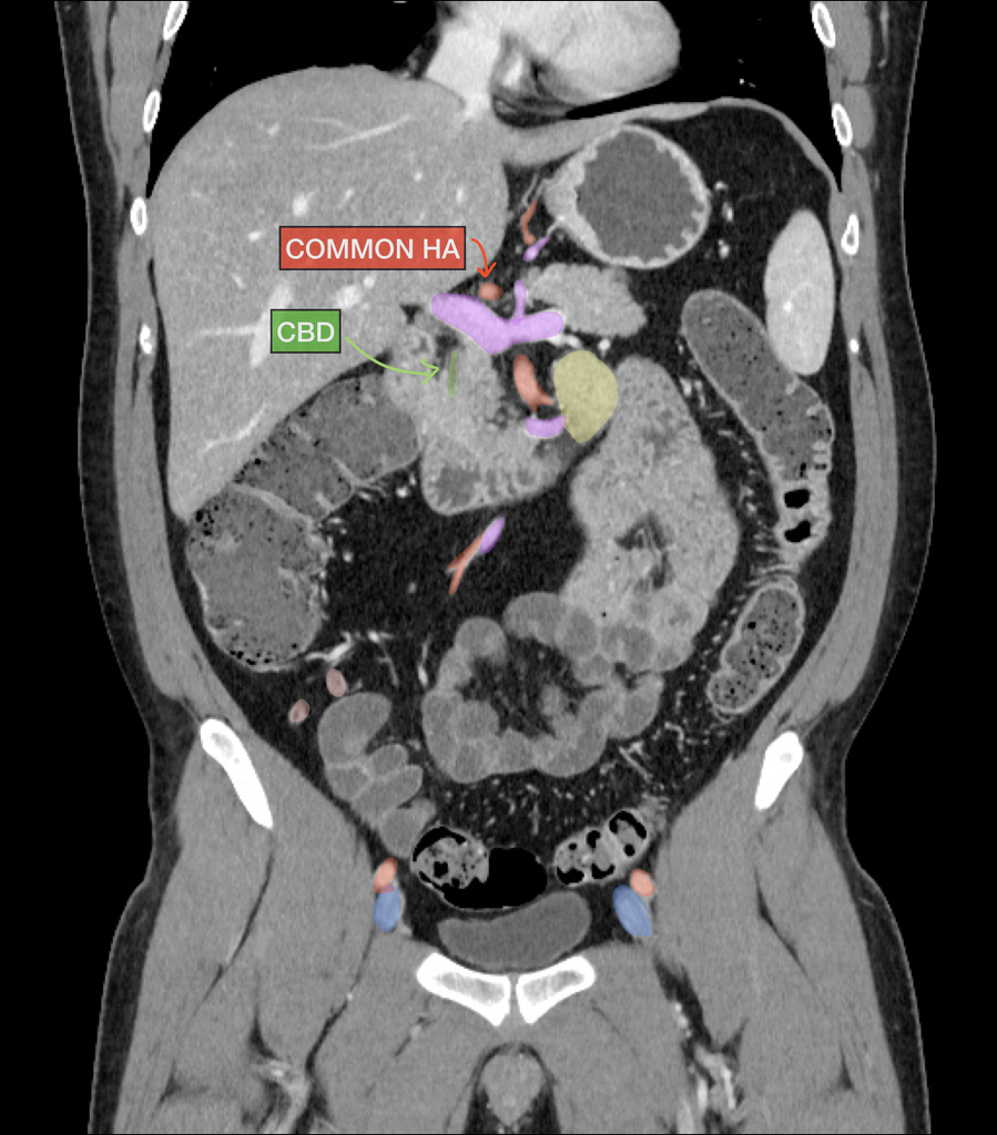 Normal Ct Scan Abdomen