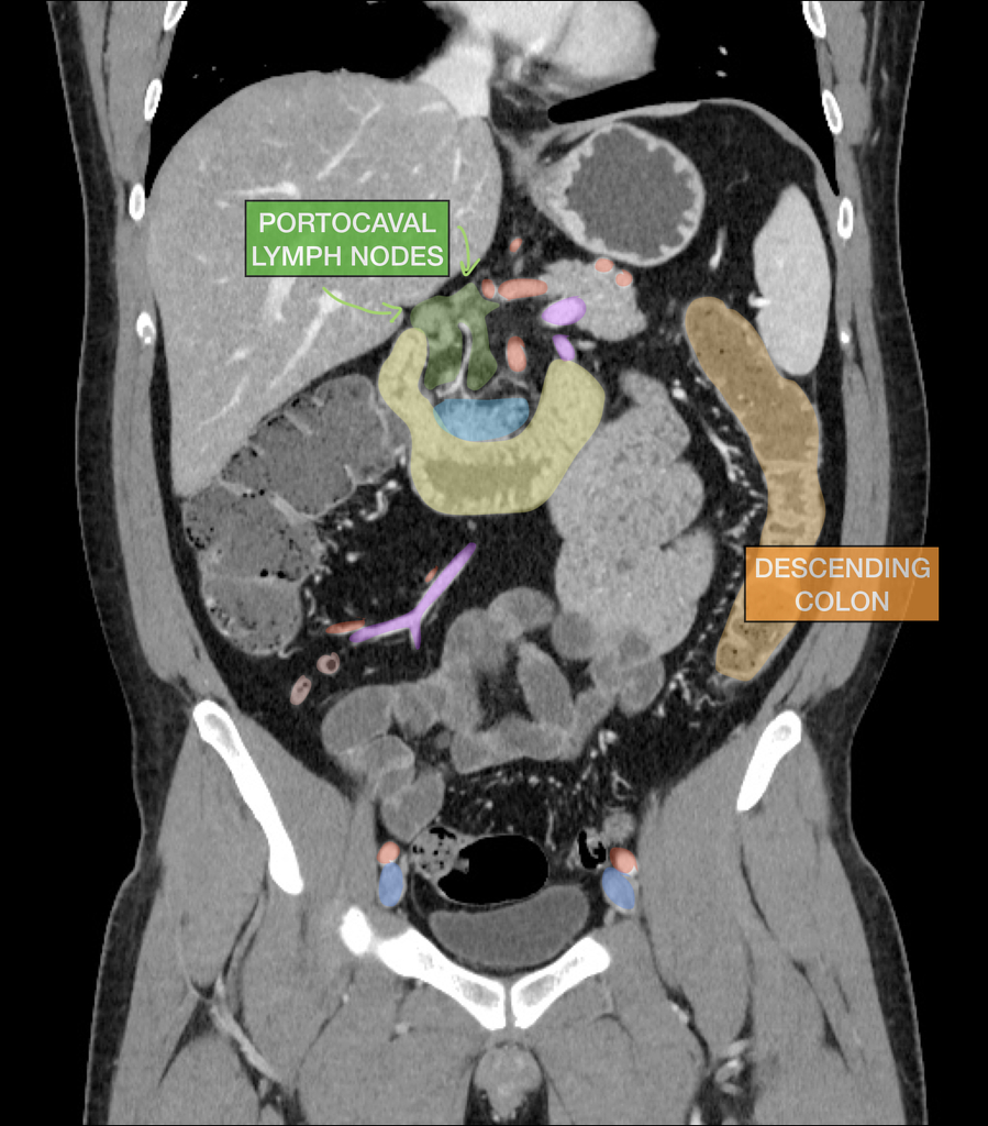 Radiology Quiz 66174 | Radiopaedia.org | Playlist 'abdomen' by 