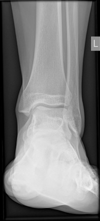 Distal tibiofibular syndesmotic injury - subacute | Radiology Case ...