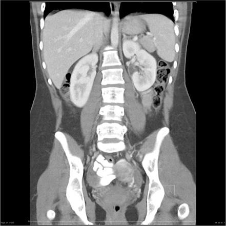 Bilateral ureteritis and cystitis | Image | Radiopaedia.org