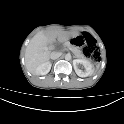 Hepatic Hydatid Cyst Compressing The Left Portal Vein Image