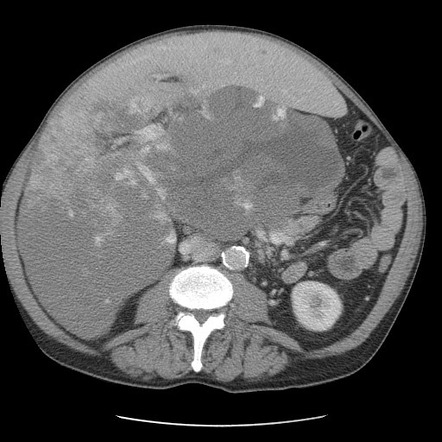 Giant hepatic cavernous hemangioma, pancreatitis | Image | Radiopaedia.org