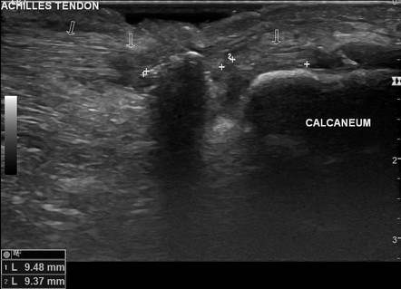 Achilles tendon laceration | Radiology Case | Radiopaedia.org