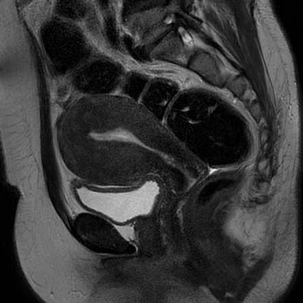 Diffuse adenomyosis | Image | Radiopaedia.org