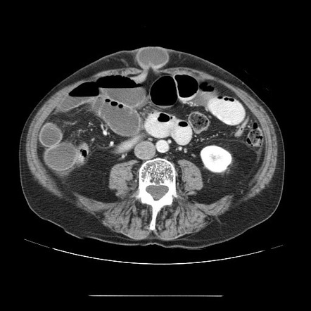 Umbilical Hernia CT Scan