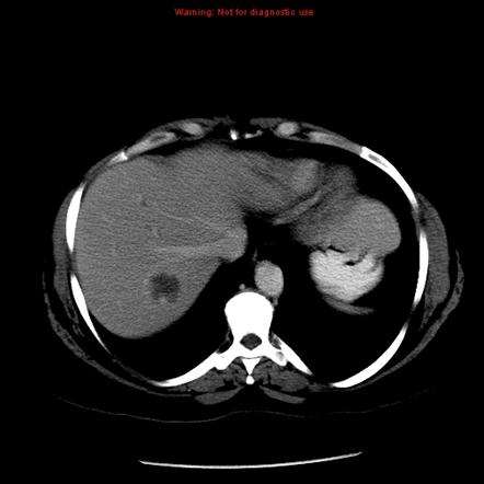 Hepatic Hemangioma Radiology Reference Article Radiopaedia Org