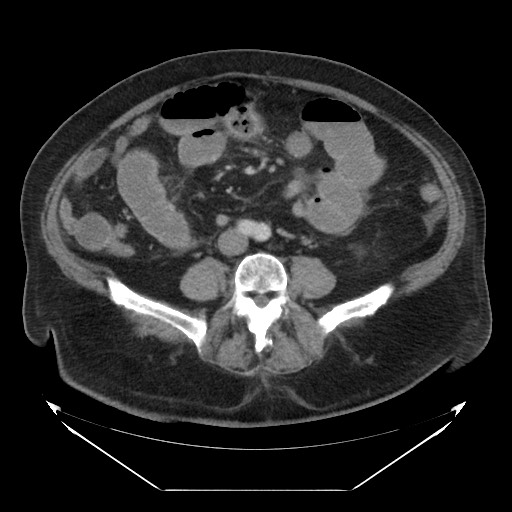 Jejunal Diverticulitis With Migration Of A Large, Obstructing 