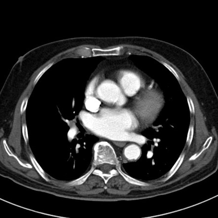 Replaced left and right hepatic arteries | Radiology Case | Radiopaedia.org