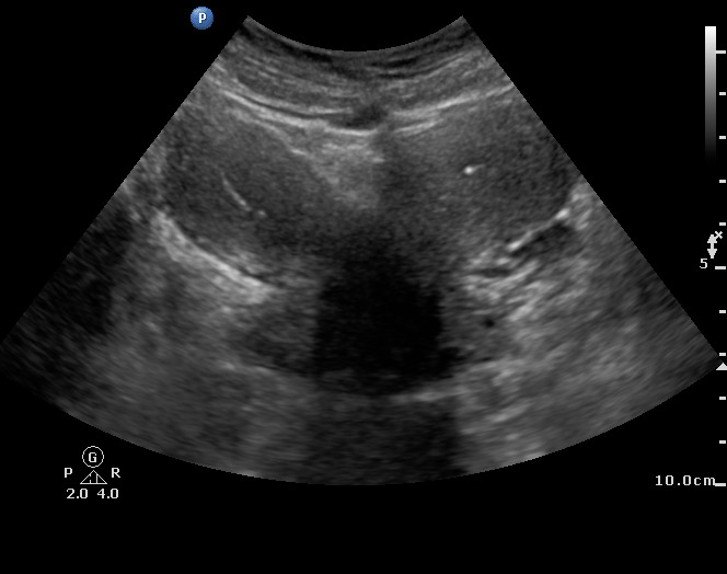 Uterus didelphys | Image | Radiopaedia.org