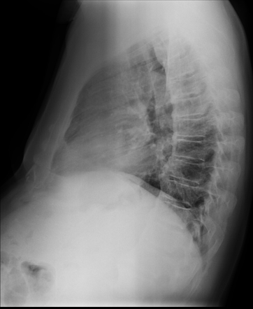 Diffuse idiopathic skeletal hyperotosis | Image | Radiopaedia.org