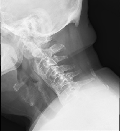 Diffuse idiopathic skeletal hyperotosis | Radiology Case | Radiopaedia.org