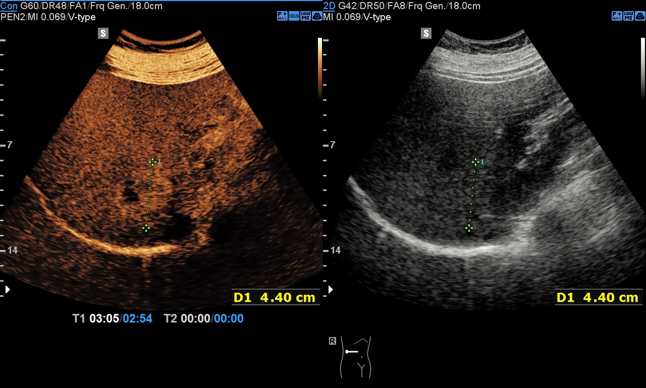 Focal nodular hyperplasia (CEUS) | Image | Radiopaedia.org