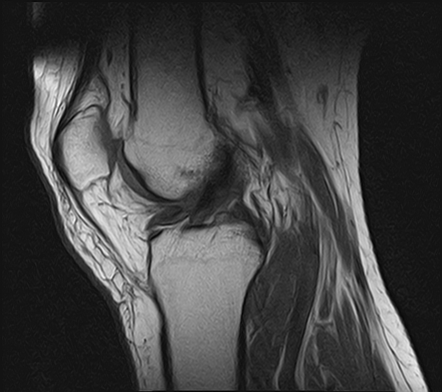 Osteochondritis dissecans - knee | Radiology Case | Radiopaedia.org