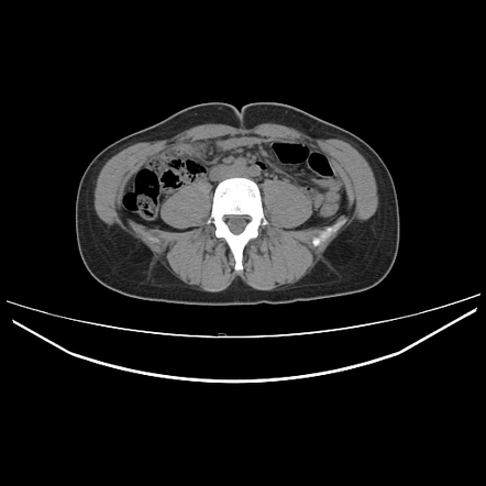 Seminal vesicle and prostatic abscesses with vasitis | Image ...