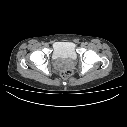 Seminal vesicle and prostatic abscesses with vasitis | Radiology Case ...