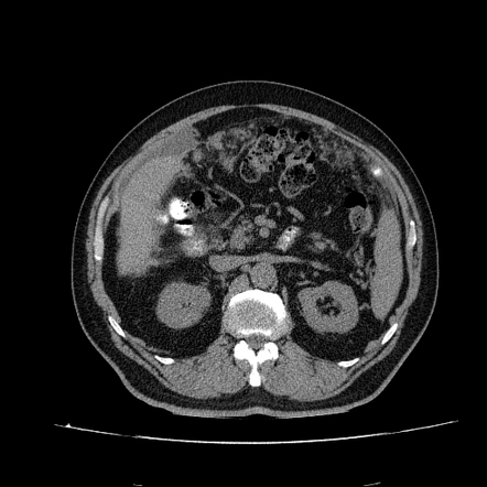 Mucinous Adenocarcinoma Of The Appendix And Pseudomyxoma Peritonei Radiology Case