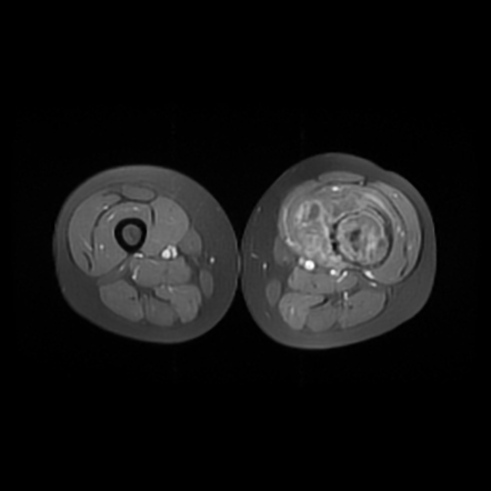 Telangiectatic osteosarcoma | Image | Radiopaedia.org